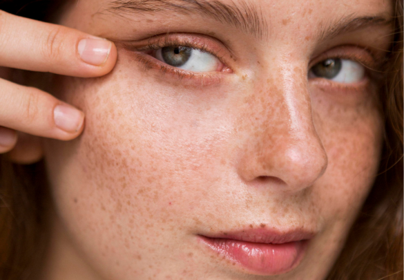 Descubre cómo tratar las manchas solares en la piel